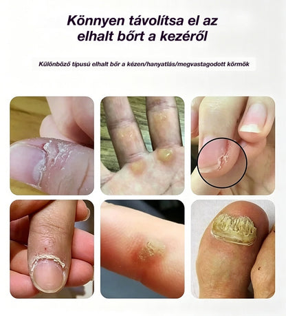 💅👍 Elektromos körömreszelő az onychomycosis kezelésére